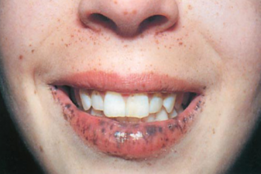 Phát hiện bệnh hiếm từ miệng có nhiều nốt sậm màu